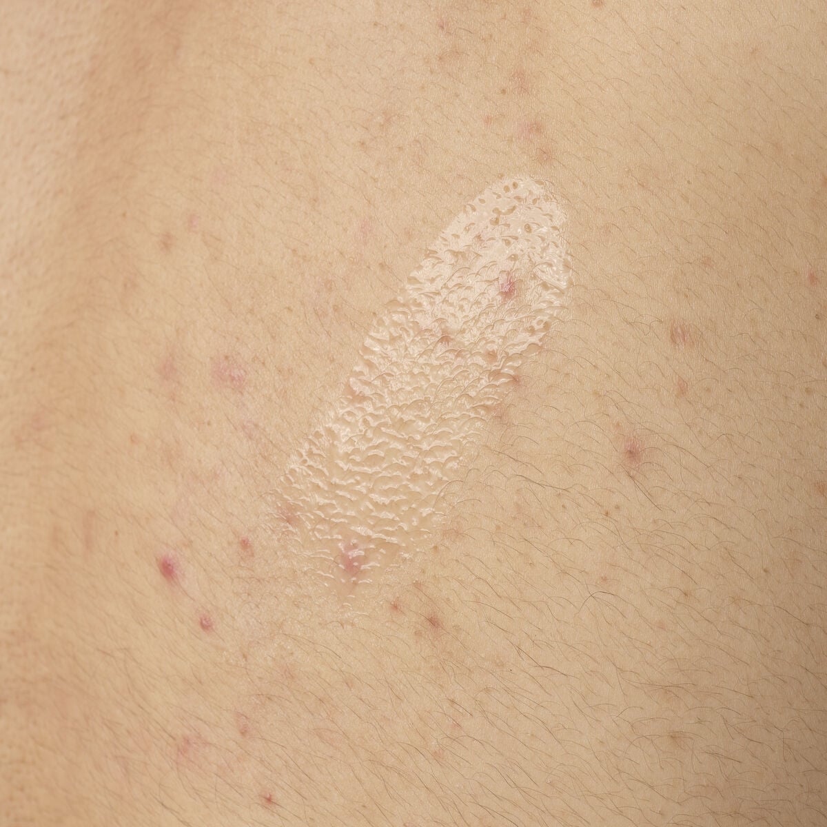 salicylic-acid-0-5-body-serum-v8 ORD-salicylic-acid-05-body-240ml-application.jpg