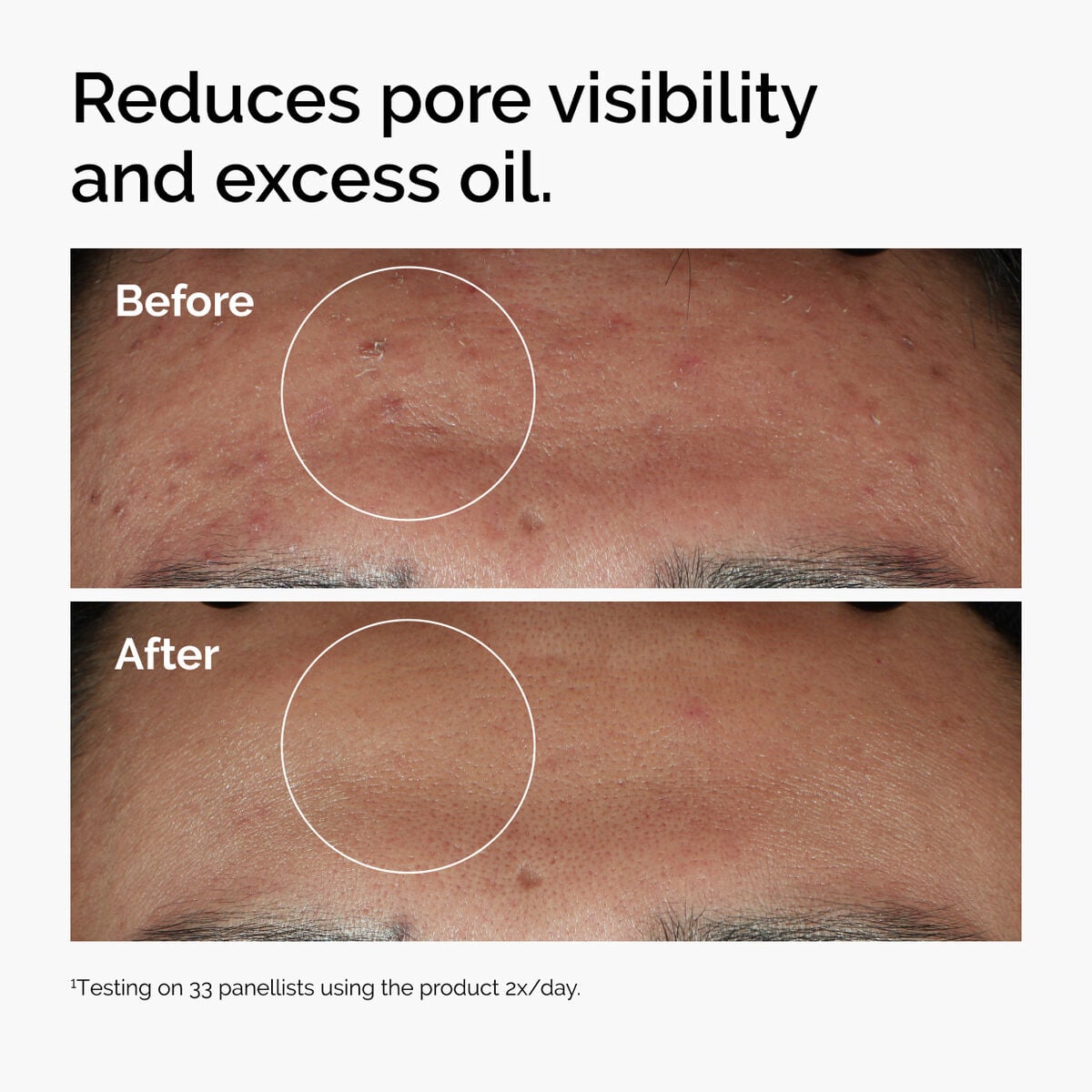niacinamide-10-zinc-1-a3 ord-niacinamide-zinc-blemish-serum-before-after-pores.jpg