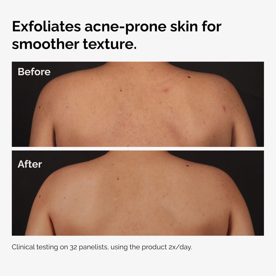 the-body-care-collection-w7 ord-salicylic-acid-body-serum-before-after-graphic-NA.jpg