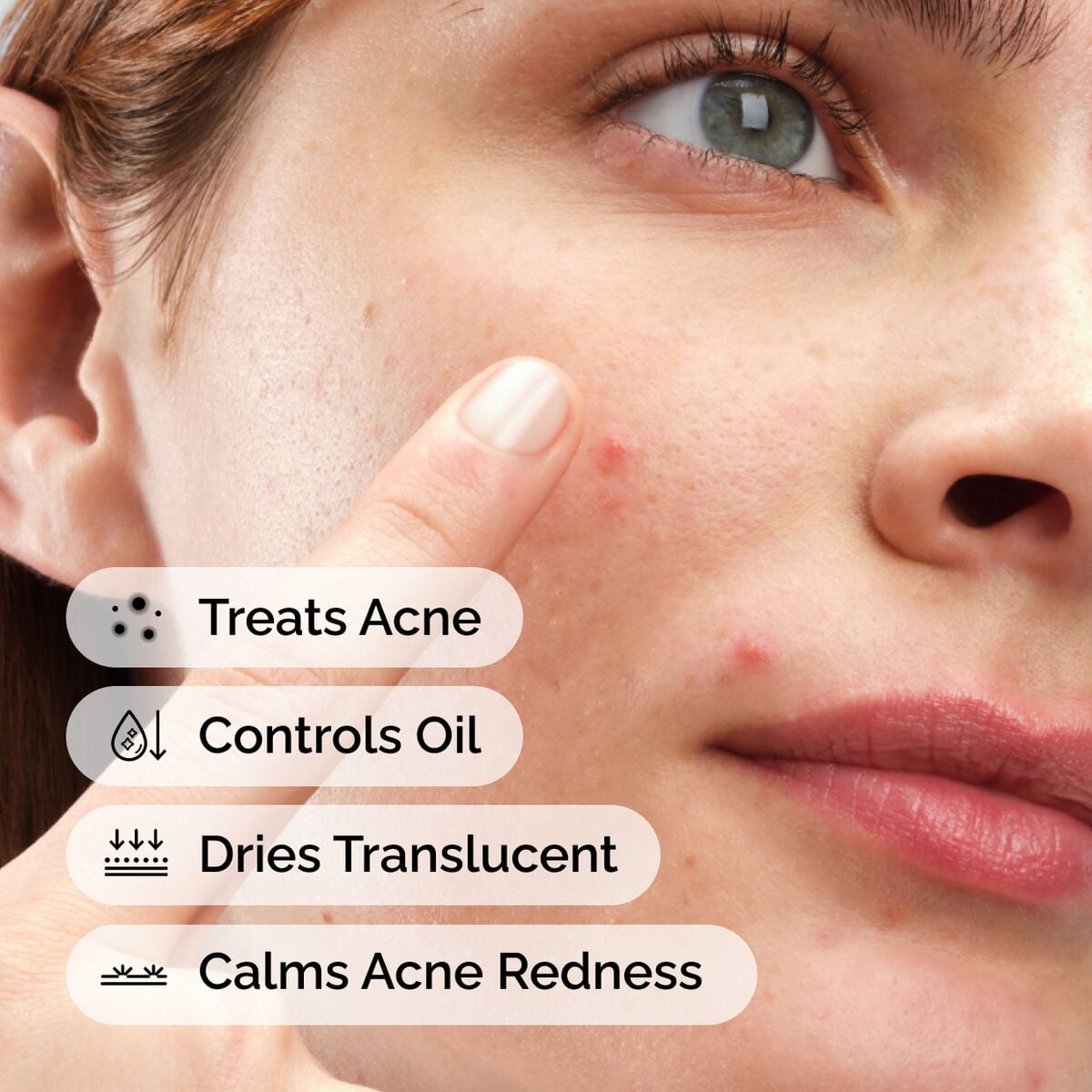 sulfur-10-powder-to-cream-concentrate-c8 ord-sulfur-10pct-powder-to-cream-concentrate-model-application-with-benefits-acne.jpg