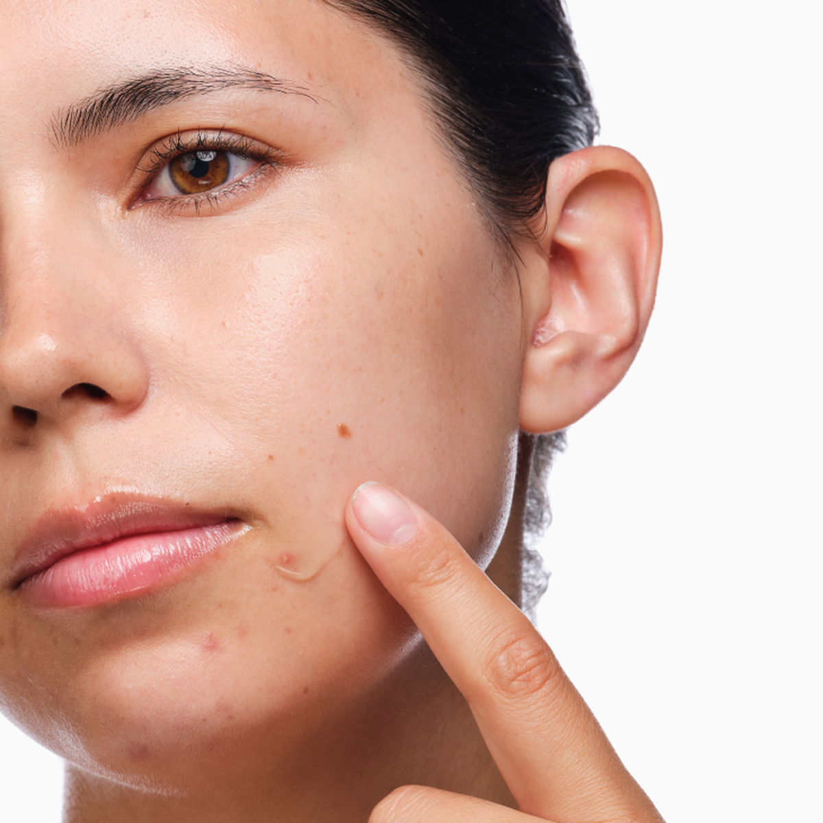 the-acne-set-g6 rdn-the-acne-set-application.png